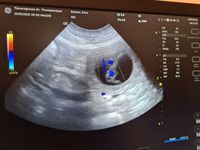 Ultraschall Herz
